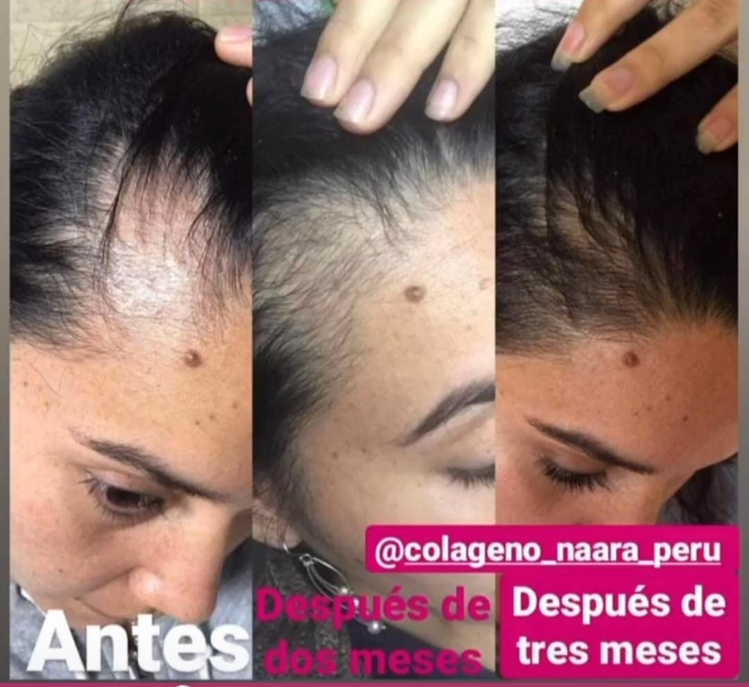 collagen Before & After